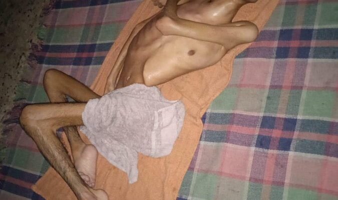 Gaza’s Youngest Victims: The Malnutrition Crisis Through the Eyes of Musab Ali Al-Dabbas