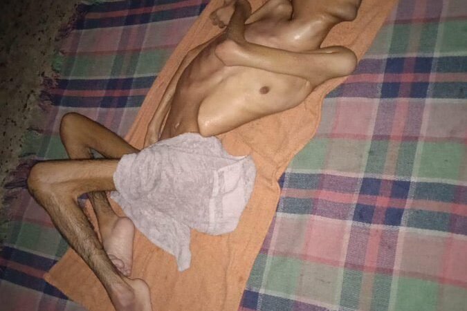 Gaza’s Youngest Victims: The Malnutrition Crisis Through the Eyes of Musab Ali Al-Dabbas